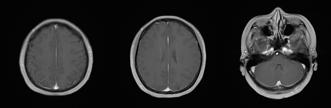 乳腺cr是什么双优标杆！从PD到18 个月达颅内CR，瑞波西利改写32岁HR+／HER2-晚期乳腺癌患者命运_https://www.jmylbn.com_新闻资讯_第8张