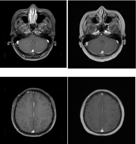 乳腺cr是什么双优标杆！从PD到18 个月达颅内CR，瑞波西利改写32岁HR+／HER2-晚期乳腺癌患者命运_https://www.jmylbn.com_新闻资讯_第10张