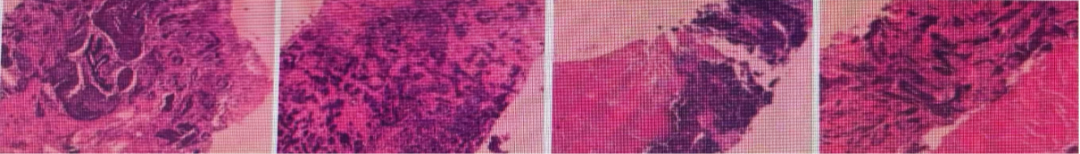 乳腺cr是什么双优标杆！从PD到18 个月达颅内CR，瑞波西利改写32岁HR+／HER2-晚期乳腺癌患者命运_https://www.jmylbn.com_新闻资讯_第3张