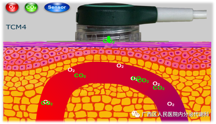 什么是经皮氧分压经皮氧分压——了解您的双足缺氧吗？_https://www.jmylbn.com_新闻资讯_第6张