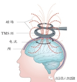 tms什么医疗【惠医惠术】神经康复治疗最新技术——从“头”开始，带你了解经颅磁刺激治疗（TMS）_https://www.jmylbn.com_新闻资讯_第5张