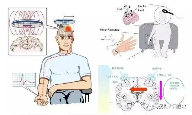 tms什么医疗【惠医惠术】神经康复治疗最新技术——从“头”开始，带你了解经颅磁刺激治疗（TMS）_https://www.jmylbn.com_新闻资讯_第4张