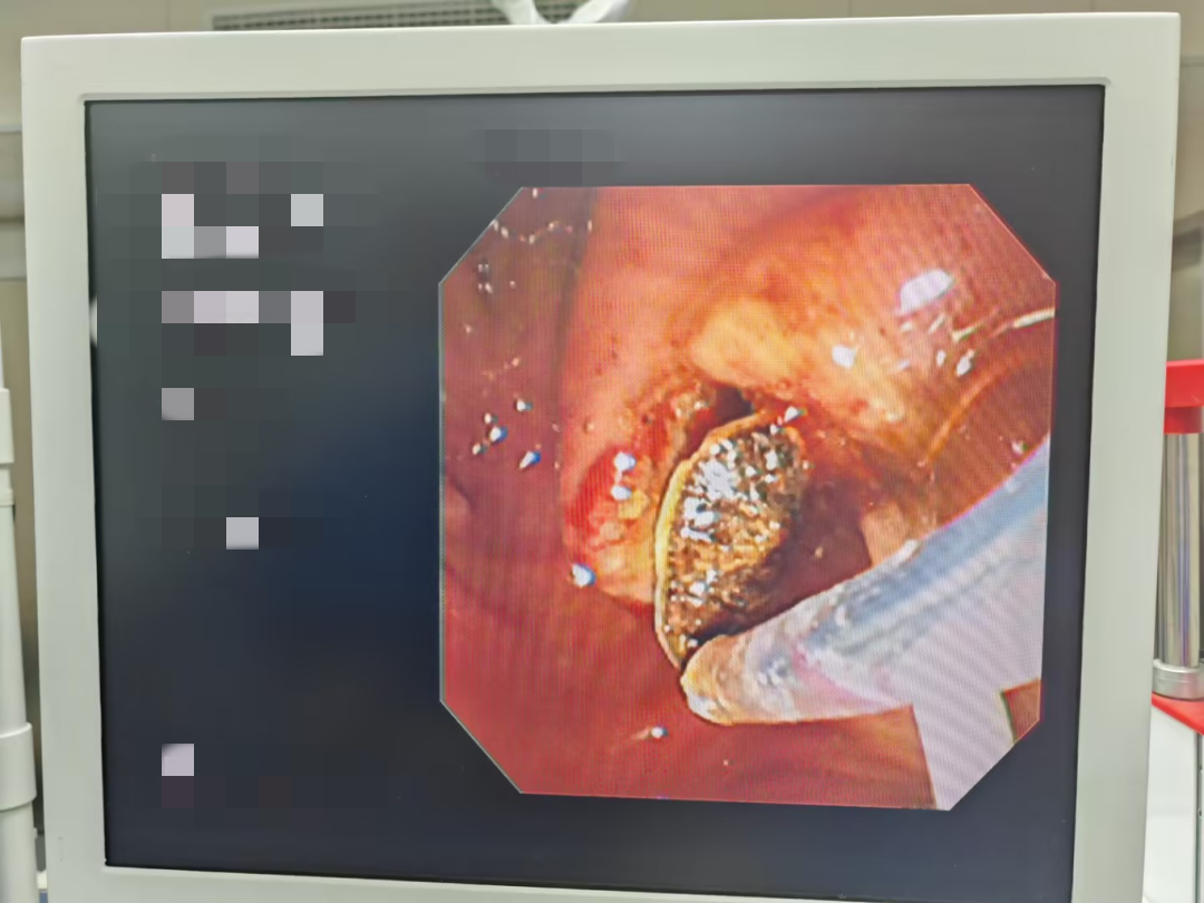 取石网篮 为什么贵一个小网篮，啷个把胆管结石取出来？_https://www.jmylbn.com_新闻资讯_第5张