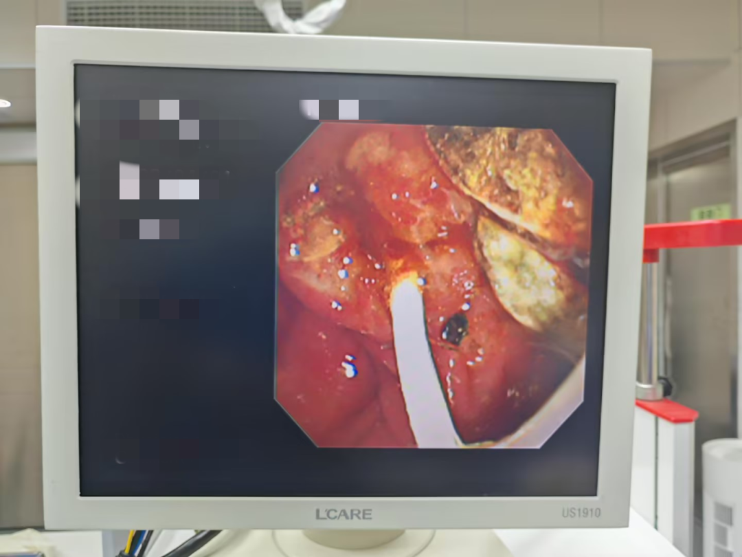 取石网篮 为什么贵一个小网篮，啷个把胆管结石取出来？_https://www.jmylbn.com_新闻资讯_第2张