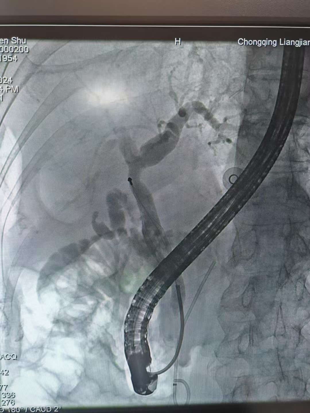 取石网篮 为什么贵一个小网篮，啷个把胆管结石取出来？_https://www.jmylbn.com_新闻资讯_第8张