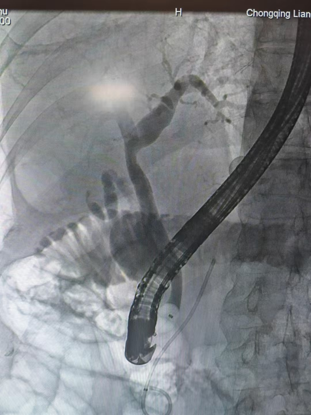 取石网篮 为什么贵一个小网篮，啷个把胆管结石取出来？_https://www.jmylbn.com_新闻资讯_第7张