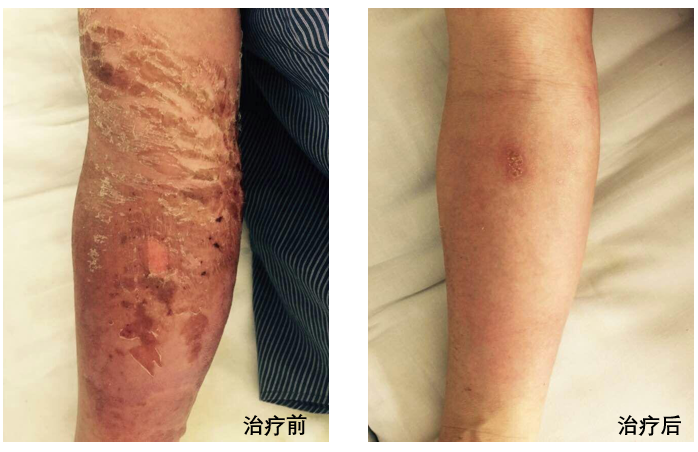 哪些单位使用水疗仪神奇的臭氧水疗，皮肤病患者的福音！_https://www.jmylbn.com_新闻资讯_第11张