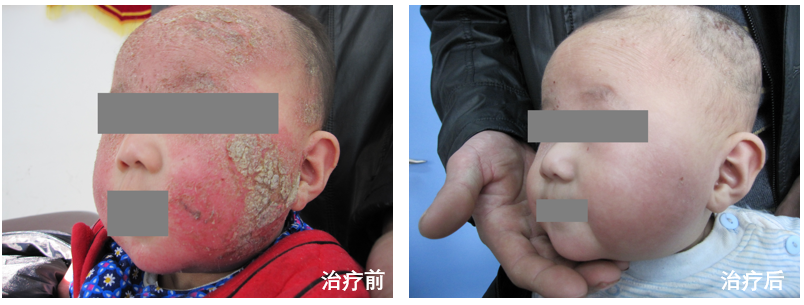 哪些单位使用水疗仪神奇的臭氧水疗，皮肤病患者的福音！_https://www.jmylbn.com_新闻资讯_第9张