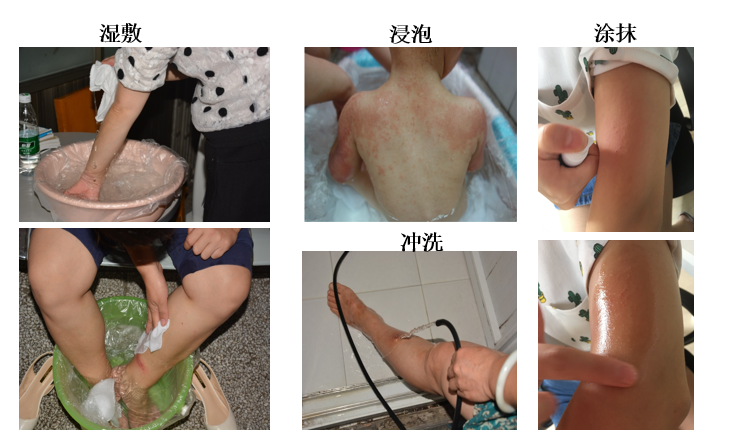 哪些单位使用水疗仪神奇的臭氧水疗，皮肤病患者的福音！_https://www.jmylbn.com_新闻资讯_第6张