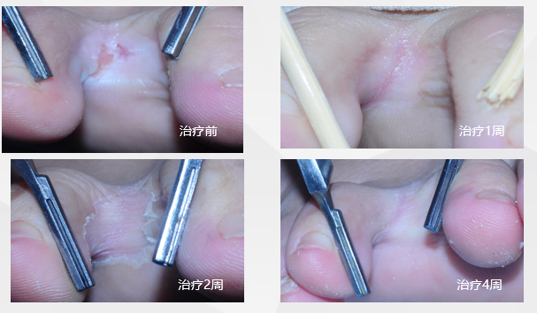 哪些单位使用水疗仪神奇的臭氧水疗，皮肤病患者的福音！_https://www.jmylbn.com_新闻资讯_第8张