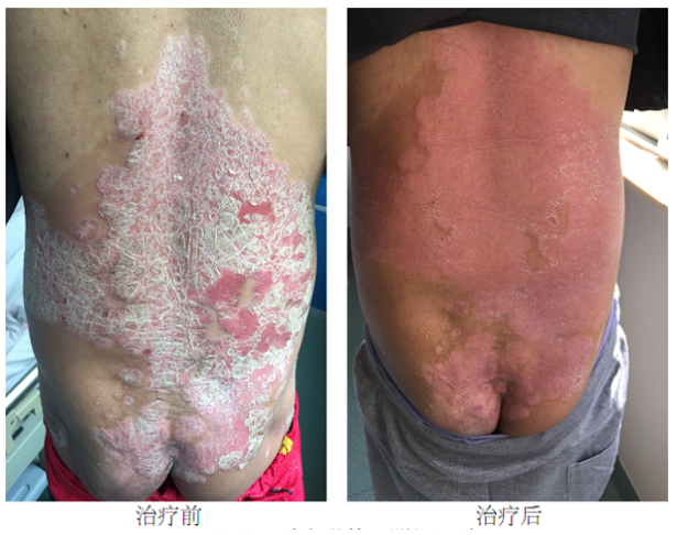 哪些单位使用水疗仪神奇的臭氧水疗，皮肤病患者的福音！_https://www.jmylbn.com_新闻资讯_第10张