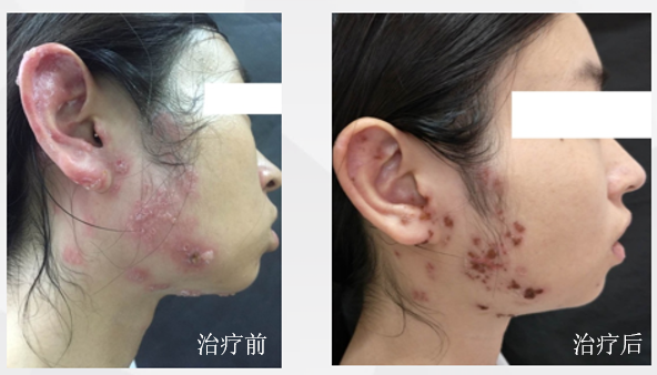 哪些单位使用水疗仪神奇的臭氧水疗，皮肤病患者的福音！_https://www.jmylbn.com_新闻资讯_第7张