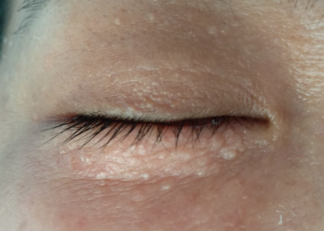 眼周的小颗粒竟然是汗管瘤,要治疗吗?什么情况应该就医?