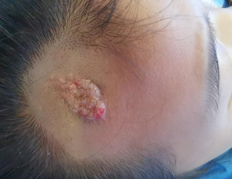 宝宝身上的"小肉疙瘩"