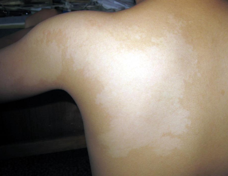 无色素痣有用内容由ai智能生成"无色素痣是一种先天性局部白斑,出生即