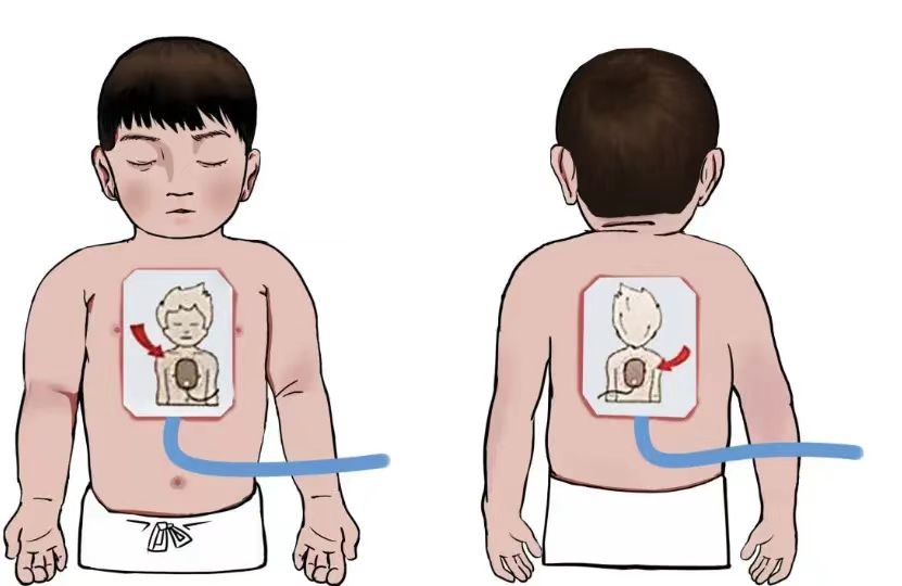 aed除颤仪怎么用应急救护 ｜ AED除颤仪的使用_https://www.jmylbn.com_新闻资讯_第4张
