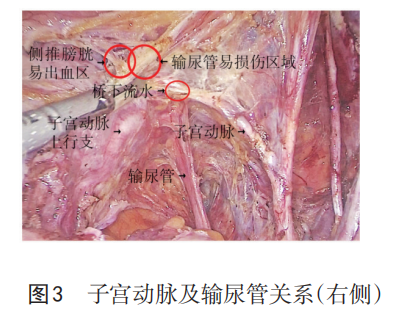 为什么要结扎血管【中国实用妇科与产科杂志微信专栏】之 821 产后出血手术缝扎止血的解剖学基础_https://www.jmylbn.com_新闻资讯_第3张