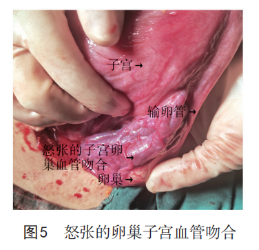 为什么要结扎血管【中国实用妇科与产科杂志微信专栏】之 821 产后出血手术缝扎止血的解剖学基础_https://www.jmylbn.com_新闻资讯_第5张