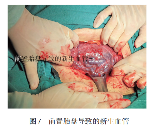 为什么要结扎血管【中国实用妇科与产科杂志微信专栏】之 821 产后出血手术缝扎止血的解剖学基础_https://www.jmylbn.com_新闻资讯_第7张