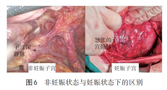 为什么要结扎血管【中国实用妇科与产科杂志微信专栏】之 821 产后出血手术缝扎止血的解剖学基础_https://www.jmylbn.com_新闻资讯_第6张
