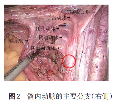 为什么要结扎血管【中国实用妇科与产科杂志微信专栏】之 821 产后出血手术缝扎止血的解剖学基础_https://www.jmylbn.com_新闻资讯_第2张