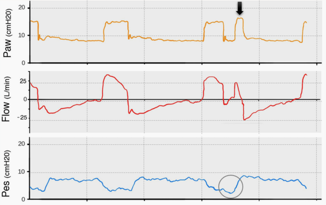 为什么呼吸机人机同步9种常见人机不同步及处理_https://www.jmylbn.com_新闻资讯_第4张