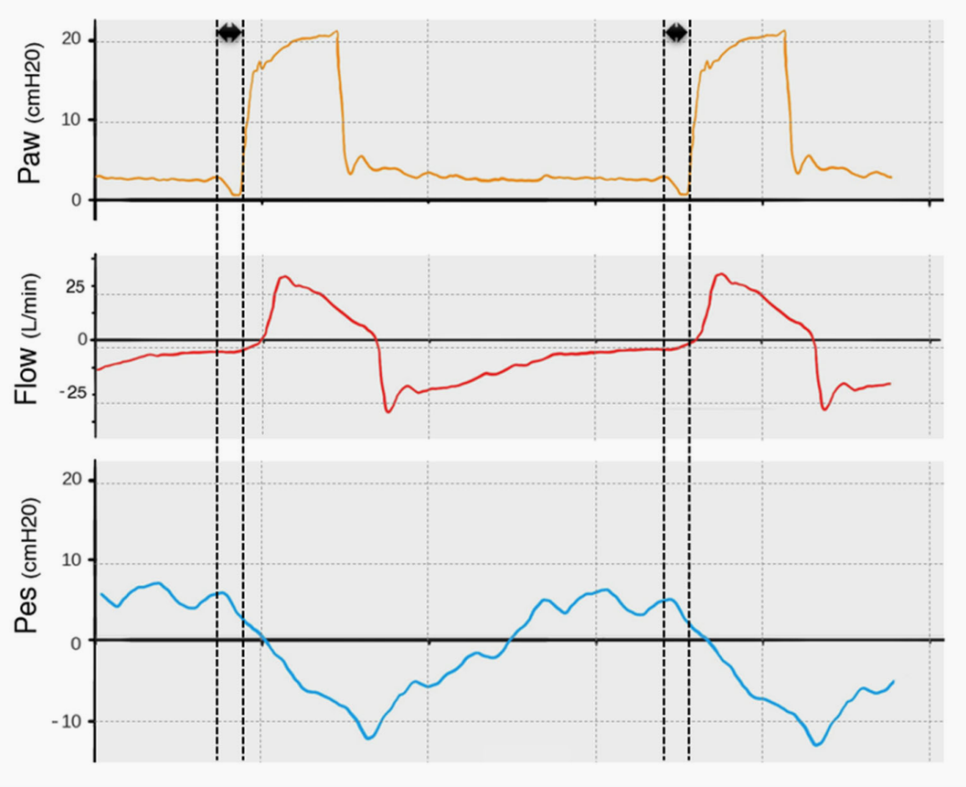 为什么呼吸机人机同步9种常见人机不同步及处理_https://www.jmylbn.com_新闻资讯_第1张