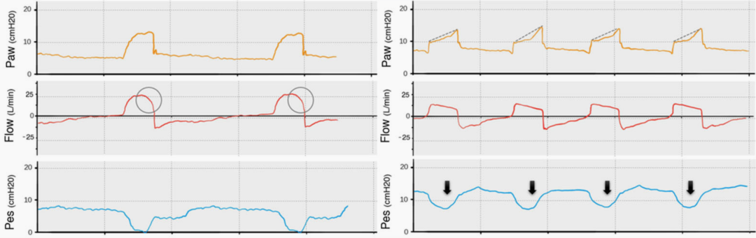 为什么呼吸机人机同步9种常见人机不同步及处理_https://www.jmylbn.com_新闻资讯_第9张