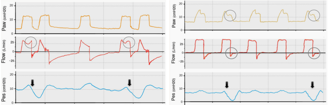 为什么呼吸机人机同步9种常见人机不同步及处理_https://www.jmylbn.com_新闻资讯_第5张