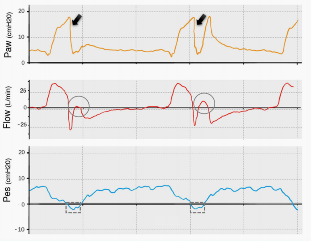 为什么呼吸机人机同步9种常见人机不同步及处理_https://www.jmylbn.com_新闻资讯_第6张