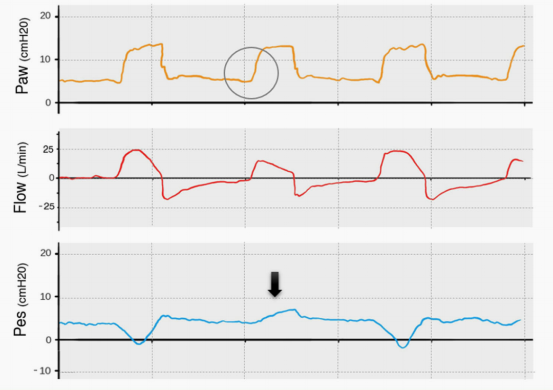 为什么呼吸机人机同步9种常见人机不同步及处理_https://www.jmylbn.com_新闻资讯_第3张