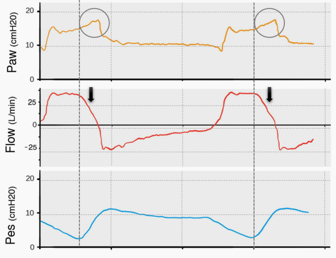 为什么呼吸机人机同步9种常见人机不同步及处理_https://www.jmylbn.com_新闻资讯_第7张
