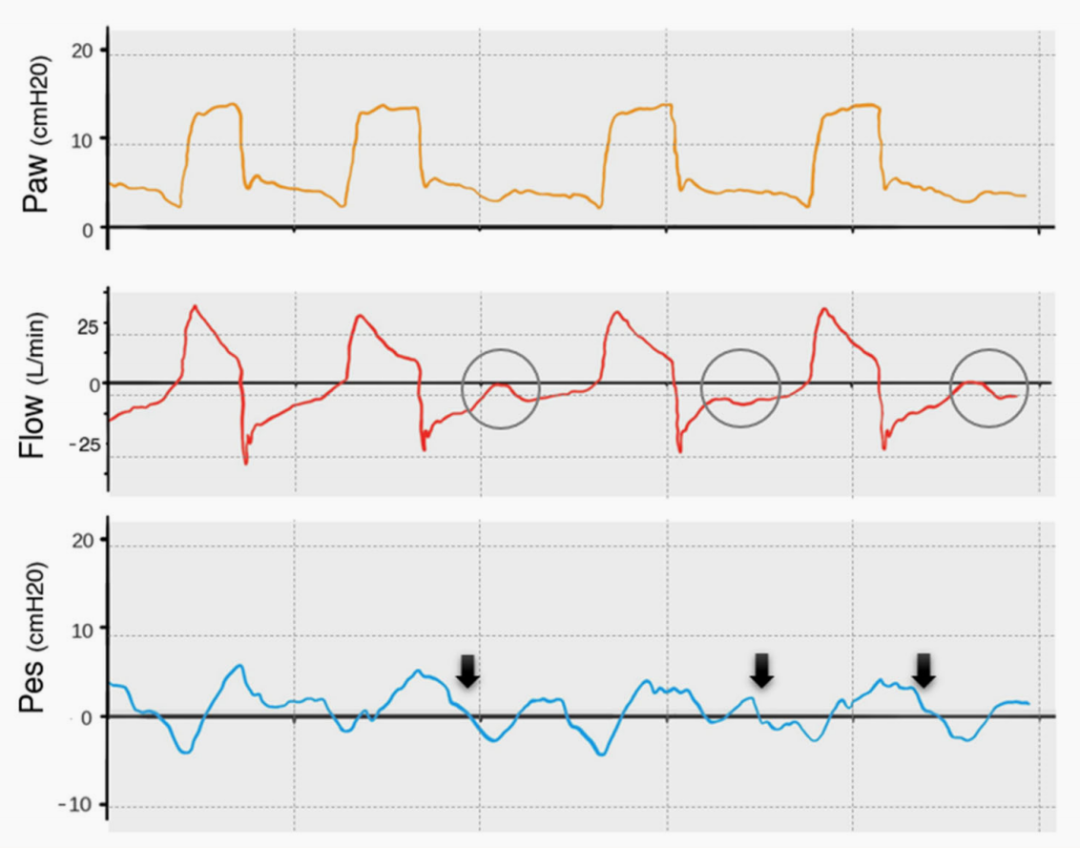 为什么呼吸机人机同步9种常见人机不同步及处理_https://www.jmylbn.com_新闻资讯_第2张