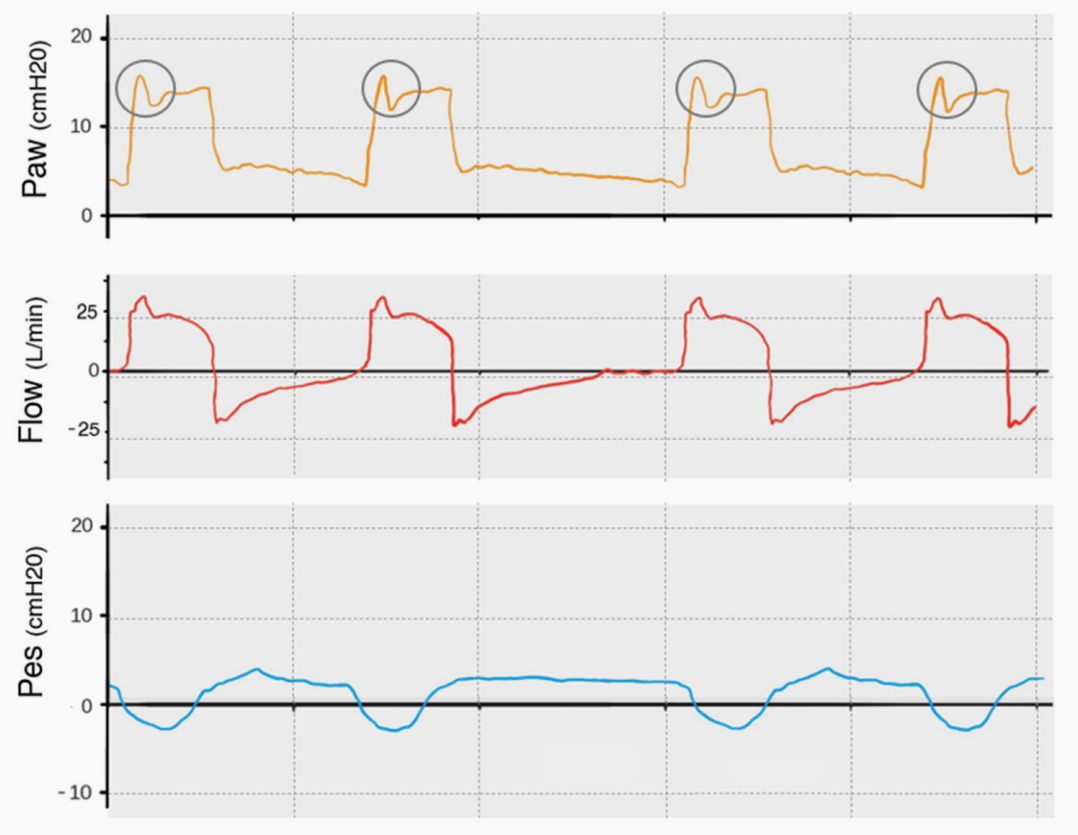 为什么呼吸机人机同步9种常见人机不同步及处理_https://www.jmylbn.com_新闻资讯_第8张