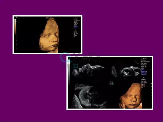 ge彩超s8怎么样中山市宝元医院引进GE Voluson S8 实时四维高端智能彩超_https://www.jmylbn.com_新闻资讯_第2张