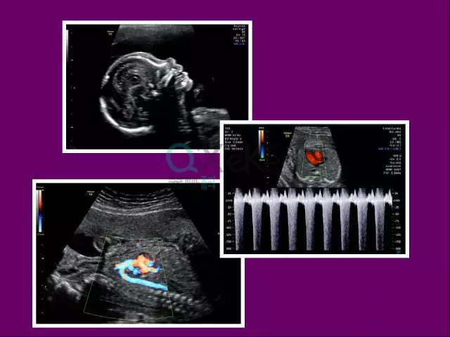 ge彩超s8怎么样中山市宝元医院引进GE Voluson S8 实时四维高端智能彩超_https://www.jmylbn.com_新闻资讯_第3张