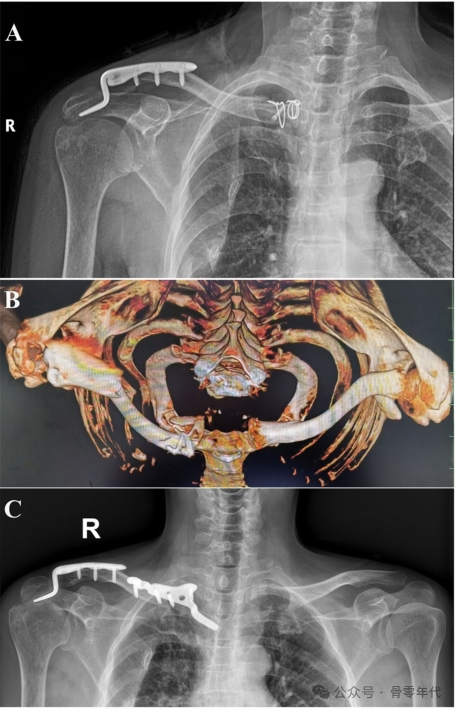 双极锁骨损伤的治疗