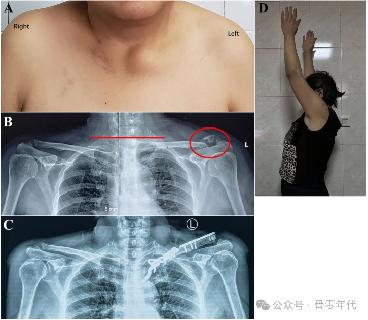 双极锁骨损伤的治疗