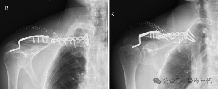 双极锁骨损伤的治疗