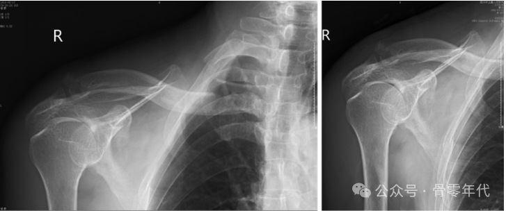 双极锁骨损伤的治疗