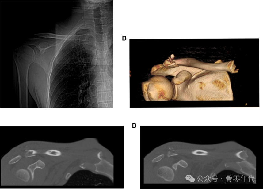 双极锁骨损伤的治疗
