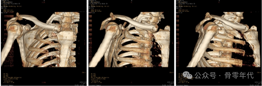 双极锁骨损伤的治疗