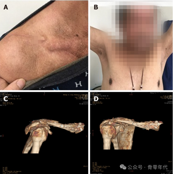 双极锁骨损伤的治疗