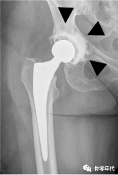 髋关节置换术后的X线片，手把手教你读懂！