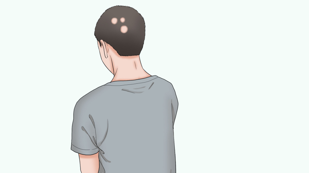 正确治疗斑秃的方式有哪些？