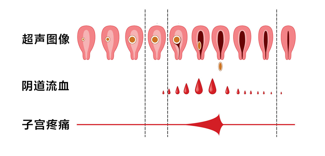 月经变少，是不是卵巢早衰了呢?