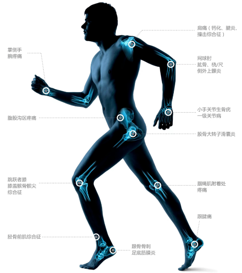 电磁治疗仪什么牌子好疼痛门诊的新利器——电磁式冲击波治疗仪，让肌骨疼痛远离您_https://www.jmylbn.com_新闻资讯_第5张
