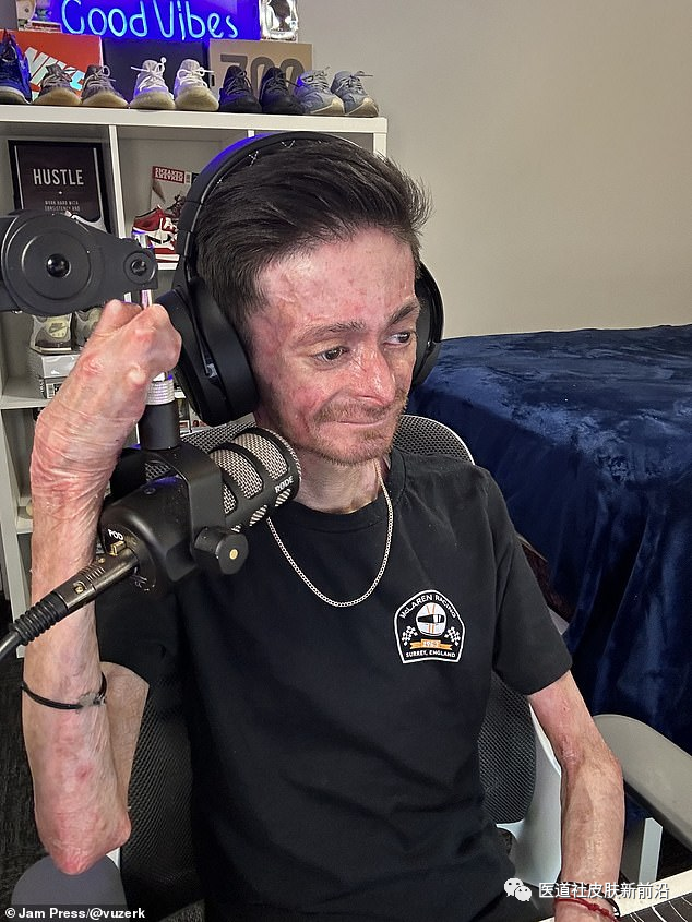 28岁的男子患有罕见的皮肤病，稍有擦伤就会留下痛苦的伤口，并可能在30多岁时杀死他，他说即使“走路和吃饭也是一场持续的战斗”