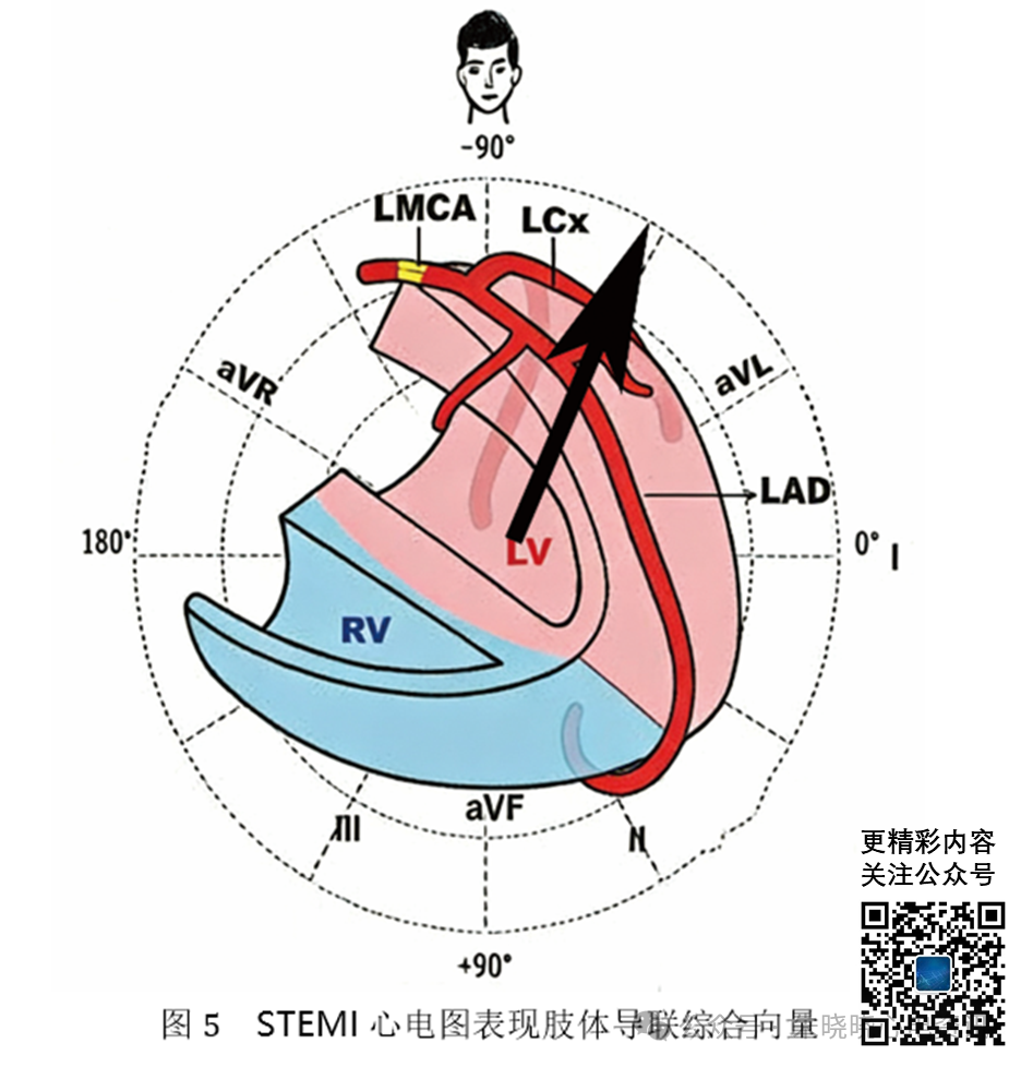 左主干急性完全闭塞的心电图特征
