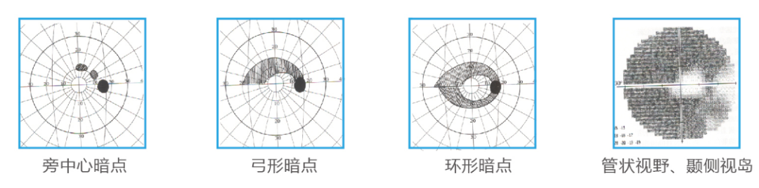 可使用降眼压药物;如果病情严重,激光和手术治疗都能达到较好的效果